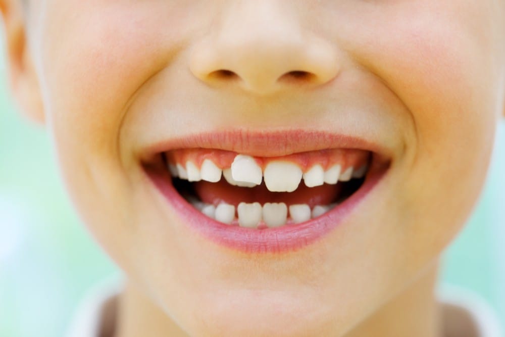 Child with crooked teeth