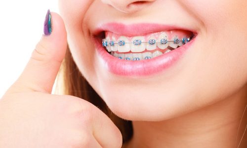 Girl with traditional metal braces